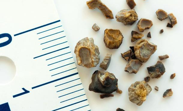 有什么食物可以預防結石的形成？深圳送菜公司?為您解讀